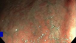 Хронический атрофический илеит (NBI, близкий фокус)